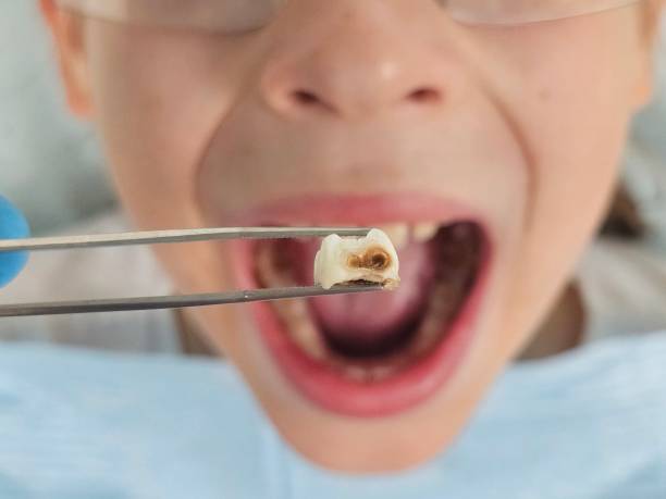 Best Urgent Care for Lost Fillings or Crowns in Hopwood, PA